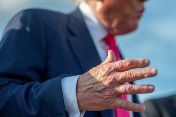 Benh suy tinh mach cua ong Trump co nguy hiem khong? hinh anh