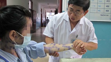 Canh giac voi benh thuy dau hinh anh
