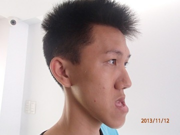 Cat ham cuu thanh nien hon 6 nam khong ngam duoc mieng hinh anh