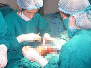 Noi thanh cong ban tay bi chem dut lia hinh anh