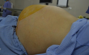Bung to nhu mang thai 8 thang vi khoi u nhay nang 6 kg hinh anh