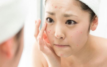 Da xau va mun trung ca - dau hieu canh bao co the thua axit hinh anh