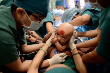 'Quyet dinh tach song sinh dinh lien tao bao nhung nhan van' hinh anh
