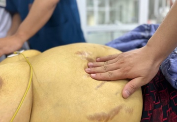 'Phá nát gan' vì sự chủ quan khi mắc viêm gan B