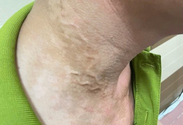 Giun nổi ngoằn ngoèo dưới da người đàn ông