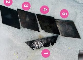 Gap 5 luoi dao ra khoi co the nam thanh nien 26 tuoi hinh anh