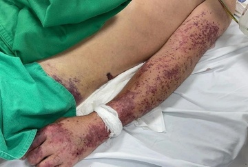 An long lon, nem chua, thanh nien 33 tuoi nhiem benh nguy hiem hinh anh