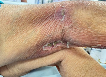 Soc nhiem khuan, ngung tim vi vet dot 'tu than' hinh anh