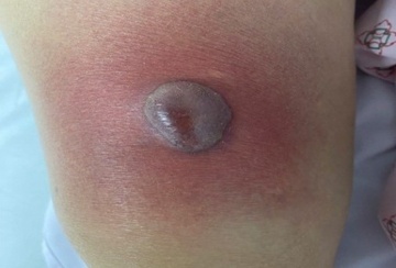 Nhung vet do tren da de doa tinh mang hinh anh