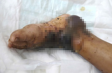 Quyet dinh chu quan cua gia dinh khien be 4 tuoi bi hoai tu chan hinh anh