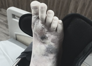 Ban chan suyt mat chi vi vet xuoc tuong vo hai hinh anh