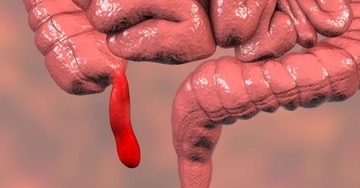 Hinh anh ruot thua vo mun nat khien bac si soc hinh anh