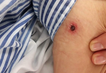 Nguy kich vi vet loet o vi tri khong ai ngo toi hinh anh