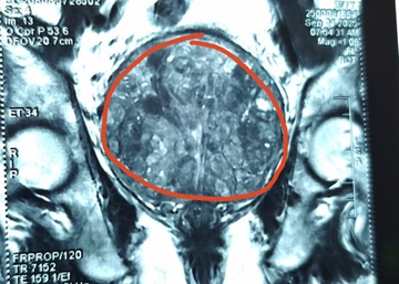 Chu quan voi benh, nguoi dan ong ganh hau qua sau nhieu nam hinh anh