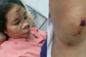 Xac minh thong tin vu cuop giat khien nguoi phu nu bi chan thuong hinh anh