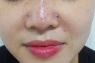 Co gai bam tim vung mui sau khi tiem filler tai spa hinh anh