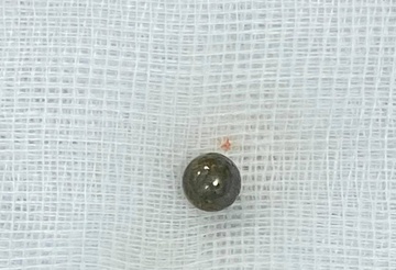 Liet nua nguoi vi bi sung tu che ban xuyen nao hinh anh