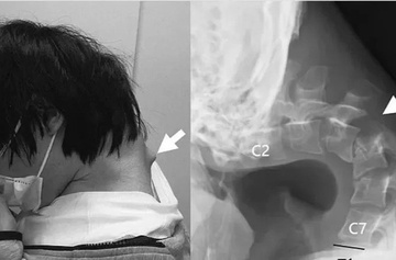Thanh niên Nhật mắc 'hội chứng rụng đầu' vì lướt điện thoại quá nhiều