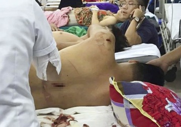 Nhom bit mat chem guc chu tiem cam do hinh anh