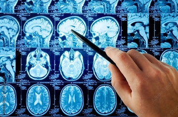 Yếu tố di truyền khiến cả làng mắc bệnh Alzheimer