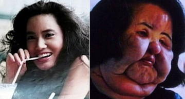 Nhung nguoi dep bien dang kinh hoang vi phau thuat tham my hinh anh