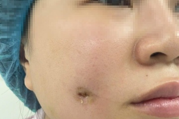 Người phụ nữ nhập viện sau khi làm đẹp tại spa