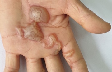 Căn bệnh 'ám ảnh' người yêu chó mèo, hàng chục nghìn ca mắc mỗi năm