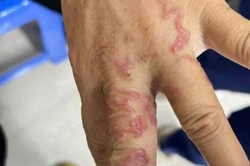 Giun bò lổm ngổm dưới da vì một thói quen ăn uống