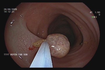 Bac si bat ngo phat hien be gai mac ung thu dai truc trang hinh anh