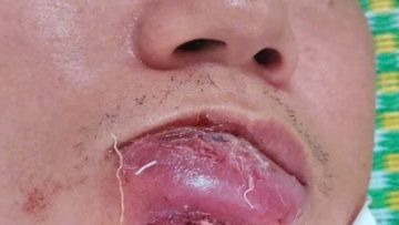 Ganh hau qua chi vi chu quan voi not mun o mep moi hinh anh