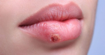 Herpes co chua khoi duoc khong? hinh anh