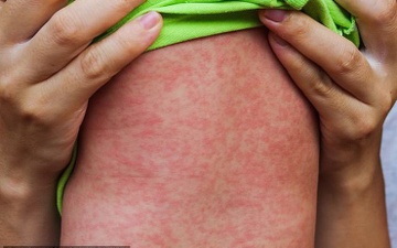 Ca mac soi tai TPHCM tang nhanh, Bo Y te de nghi tang cuong kiem soat hinh anh