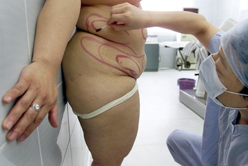 Ba me 3 con tu vong vi chi con 31 kg sau khi cat da day giam can hinh anh