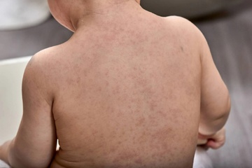 Dau hieu de nham lan giua soi va sot phat ban hinh anh