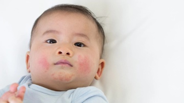 Dau hieu canh bao tre bi viem da co dia hinh anh
