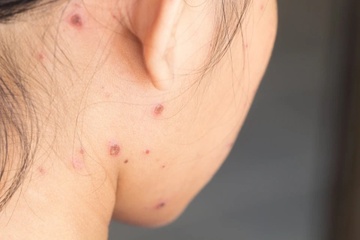 Đã từng mắc thủy đậu có cần tiêm vaccine?