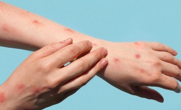 Những dấu hiệu đầu tiên của bệnh thủy đậu
