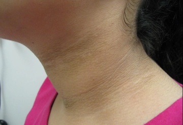 6 dau hieu chi diem ban dang bi khang insulin hinh anh