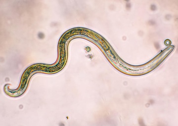 Nu benh nhan nhiem loai giun nguy hiem nhung khong biet hinh anh