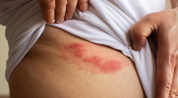 Phan biet trieu chung gioi leo va benh cham hinh anh