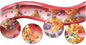 7 triệu chứng cảnh báo bạn mắc rối loạn mỡ máu