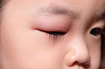 Viem bo mi mat can cham soc nhu the nao? hinh anh