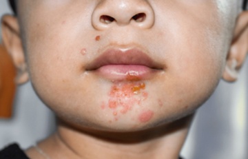 Benh choc nguy hiem the nao? hinh anh