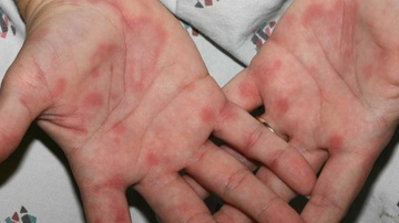 Dau hieu phat hien nhiem HIV o nam gioi hinh anh