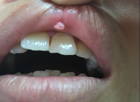 Dau hieu cua sui mao ga giai doan dau hinh anh