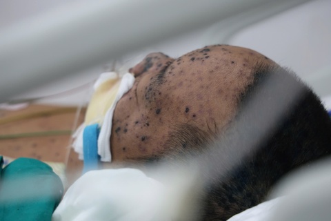 Chu quan lay benh tu con, nguoi dan ong 36 tuoi nguy kich hinh anh