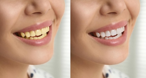 Cach cai thien rang bi o vang hinh anh