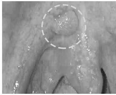 Dau hieu som cua ung thu khoang mieng hinh anh