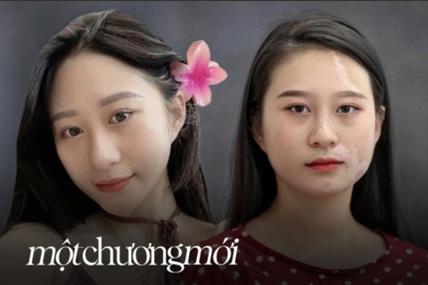 Ước mơ của cô gái xinh đẹp 20 năm bị căn bệnh tàn phá diện mạo