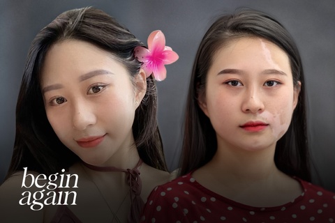 Ước mơ của cô gái xinh đẹp 20 năm bị căn bệnh tàn phá diện mạo